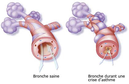 asthme_pm-2 asthme_pm-2