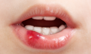 Blessure à la bouche ou aux dents chez l’enfant