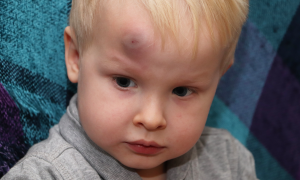 Enfant qui s’est fait une ecchymose (un bleu)