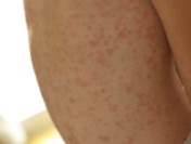 Roseola rash
