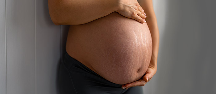 Grossesse: les vergetures
