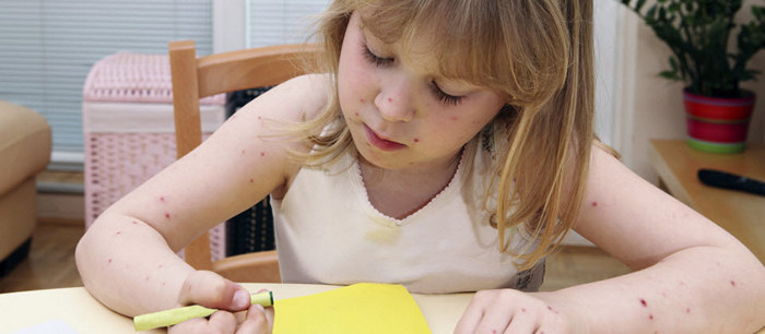 La varicelle chez l'enfant