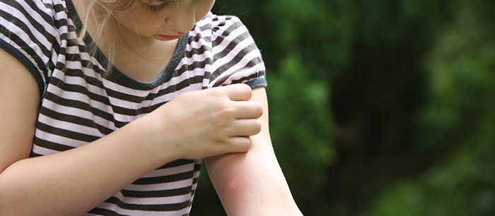 Piqûres d'insectes chez l'enfant: prévenir et traiter