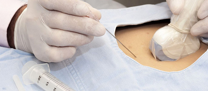 Pregnancy: Amniocentesis