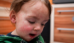 Cas de rougeole: appel à la vaccination pour stopper la progression